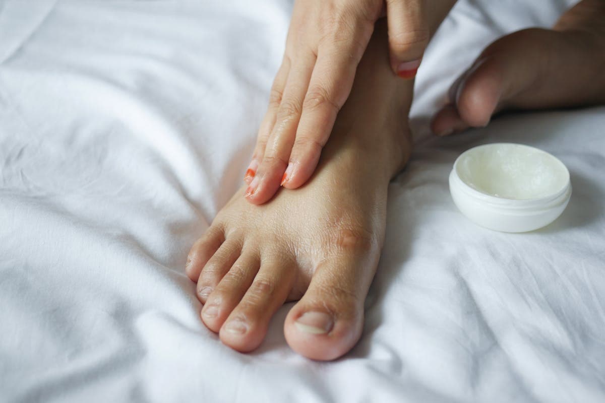 Warts and Verrucas: Over-the-Counter Pharmacy Treatments